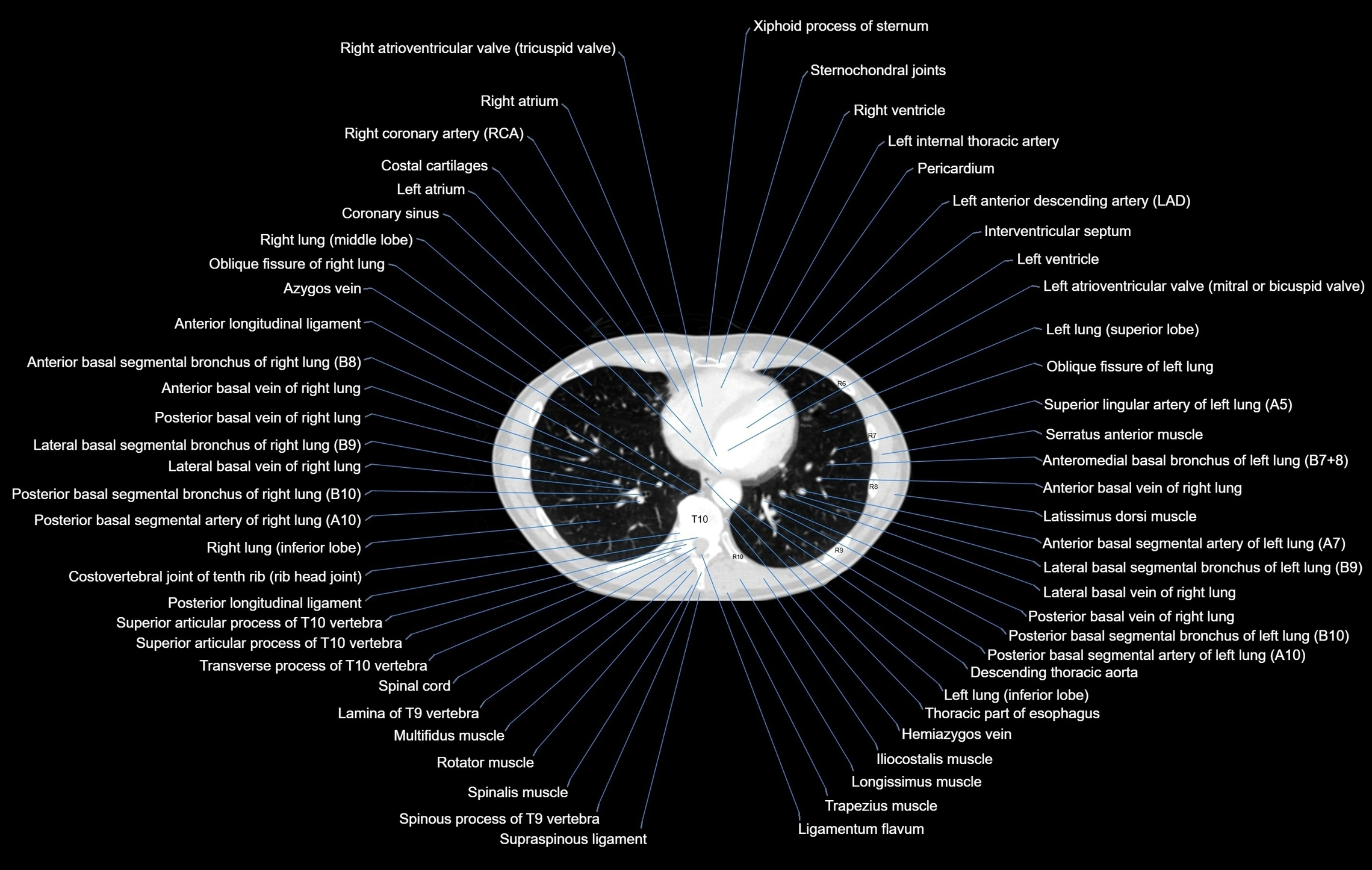 CT chest (thorax) lung window window labelled axial cross sectional anatomy radiology image-00083.webp